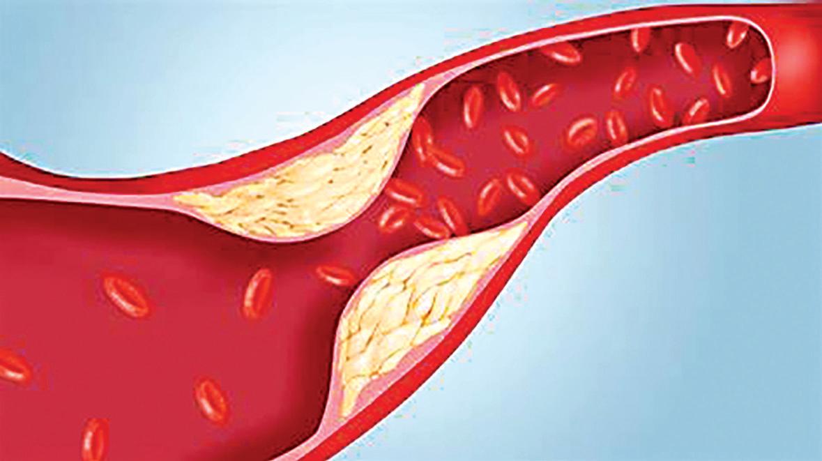 IASST designs optical sensing platform for detecting cholesterol